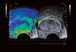 Toshiba-Aplio-Prostate-Elastography