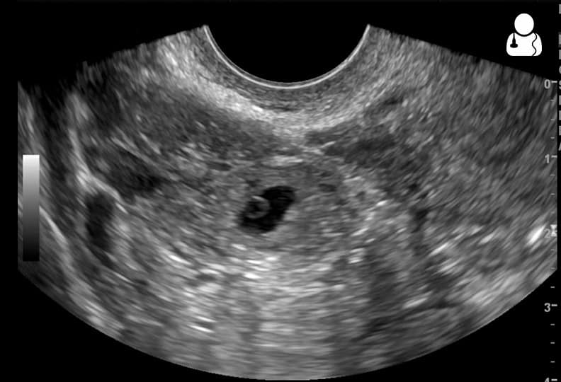 Ectopic Pregnancy